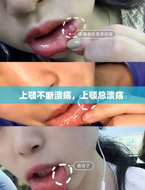 上顎不斷潰瘍，上顎總潰瘍 