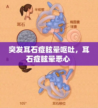 突發(fā)耳石癥眩暈嘔吐，耳石癥眩暈惡心 