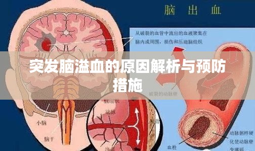 突發(fā)腦溢血的原因解析與預(yù)防措施